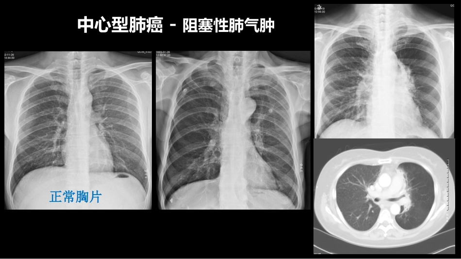 肺癌的综合影像学诊断_第11页
