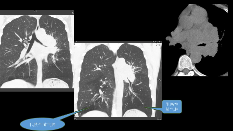 肺癌的综合影像学诊断_第12页
