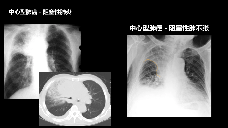 肺癌的综合影像学诊断_第13页