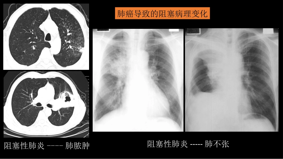 肺癌的综合影像学诊断_第14页
