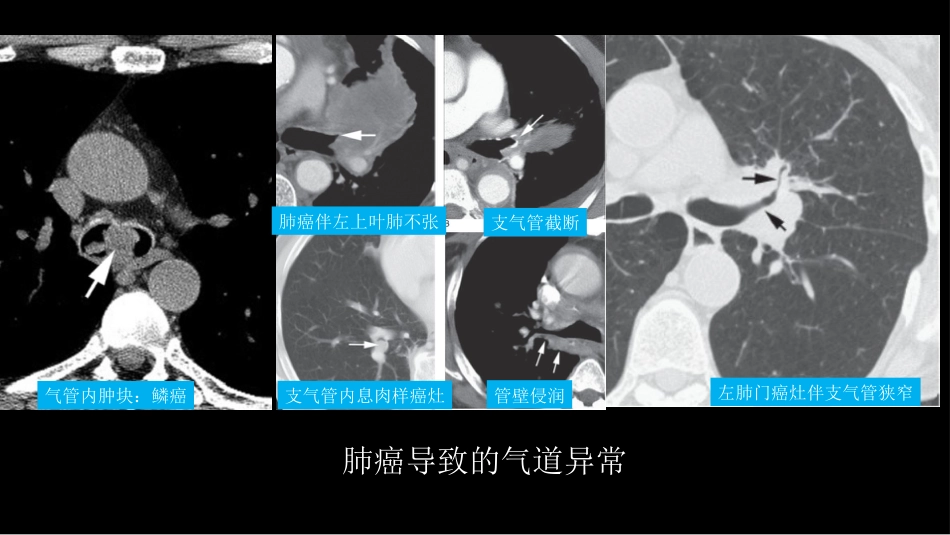 肺癌的综合影像学诊断_第15页