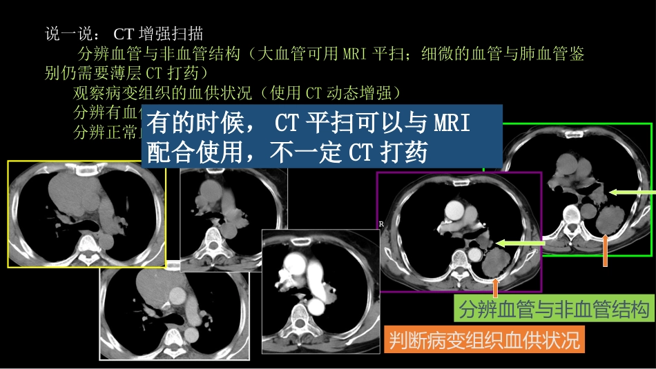 肺癌的综合影像学诊断_第7页