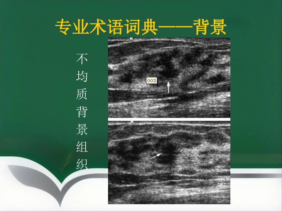 超声乳腺影像报告和数据系统BI-RADS解读_第11页