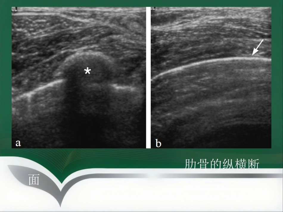 超声乳腺影像报告和数据系统BI-RADS解读_第14页