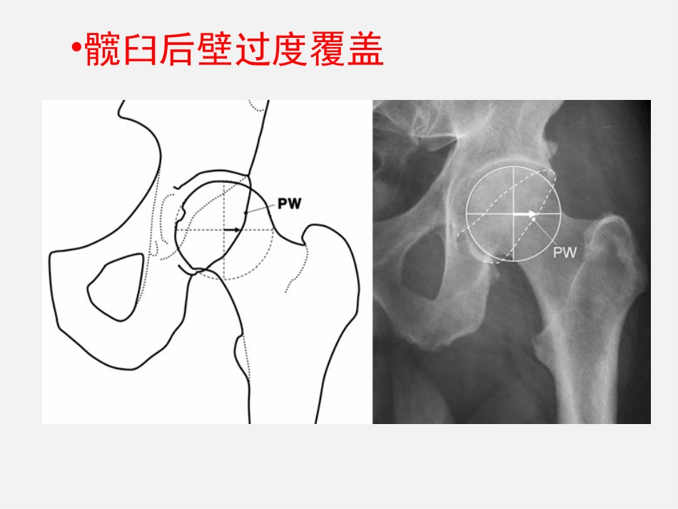成人正常髋关节影像学_第11页