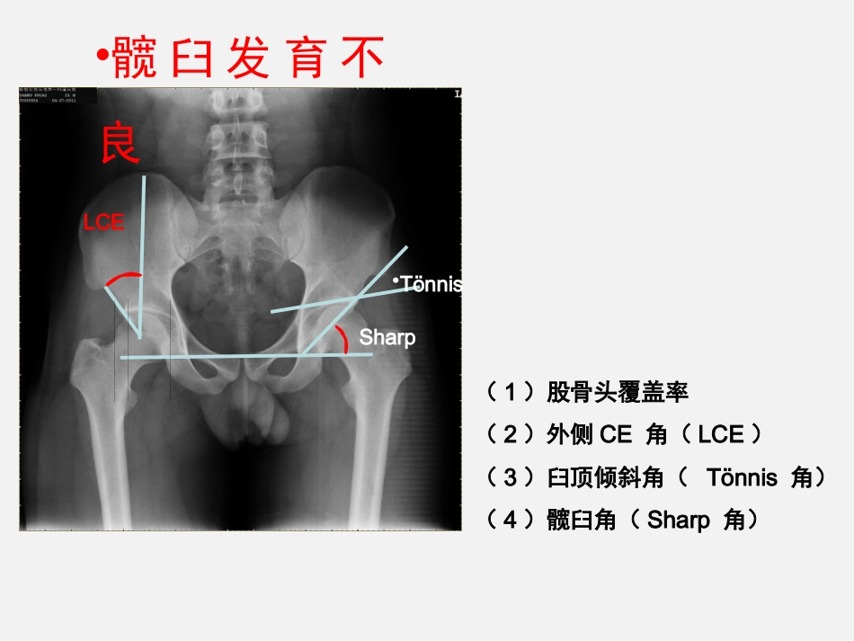 成人正常髋关节影像学_第6页