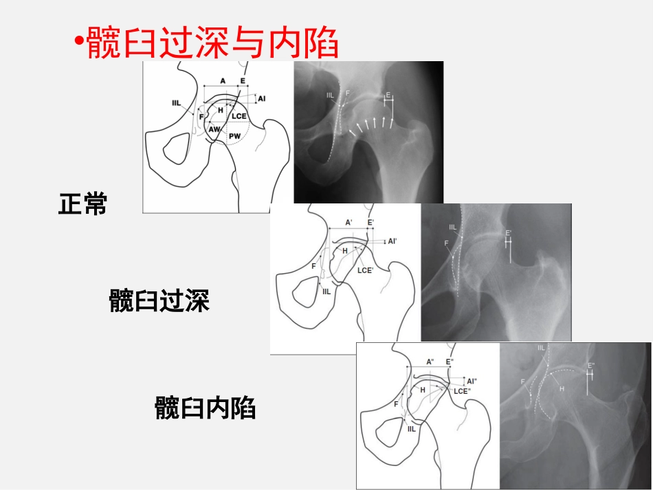 成人正常髋关节影像学_第9页