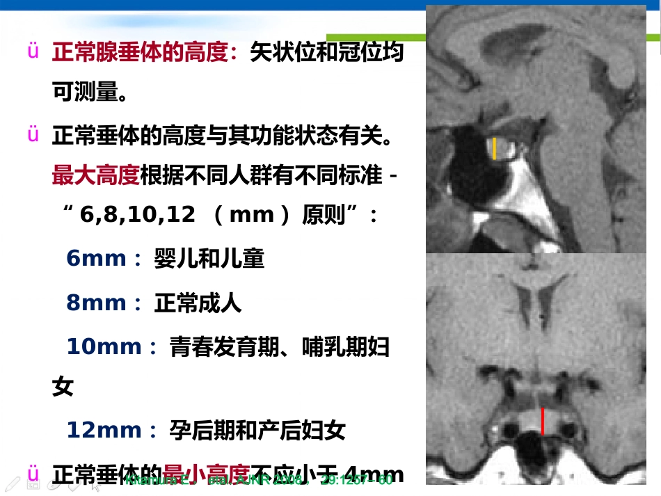 垂体病变的影像学诊断规范_第11页
