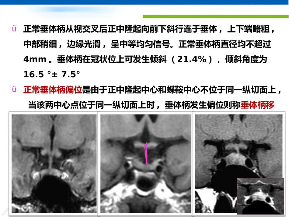 垂体病变的影像学诊断规范_第13页