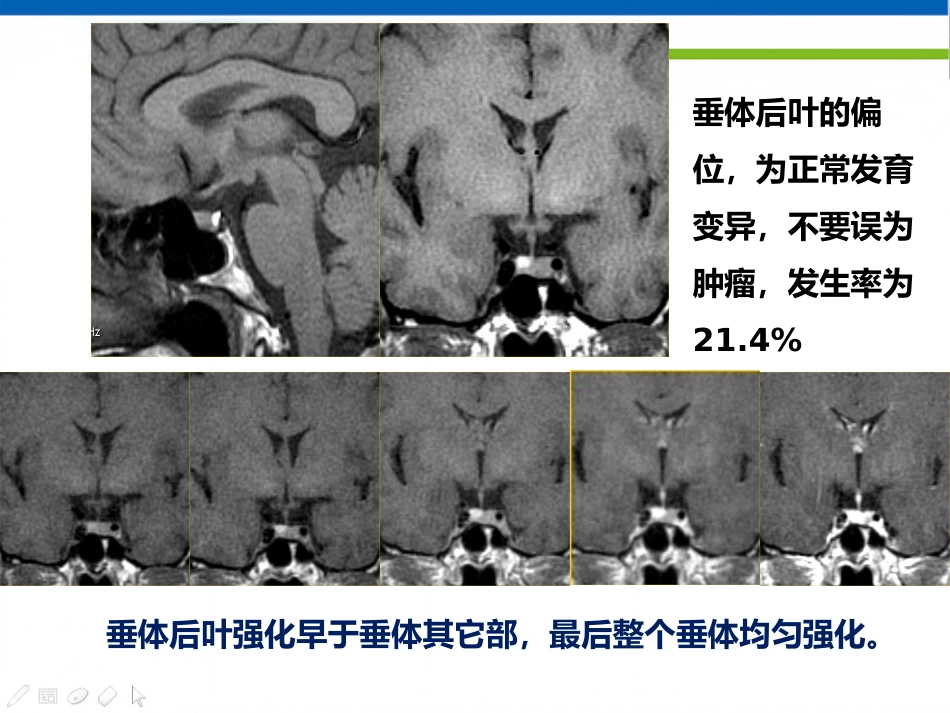 垂体病变的影像学诊断规范_第14页