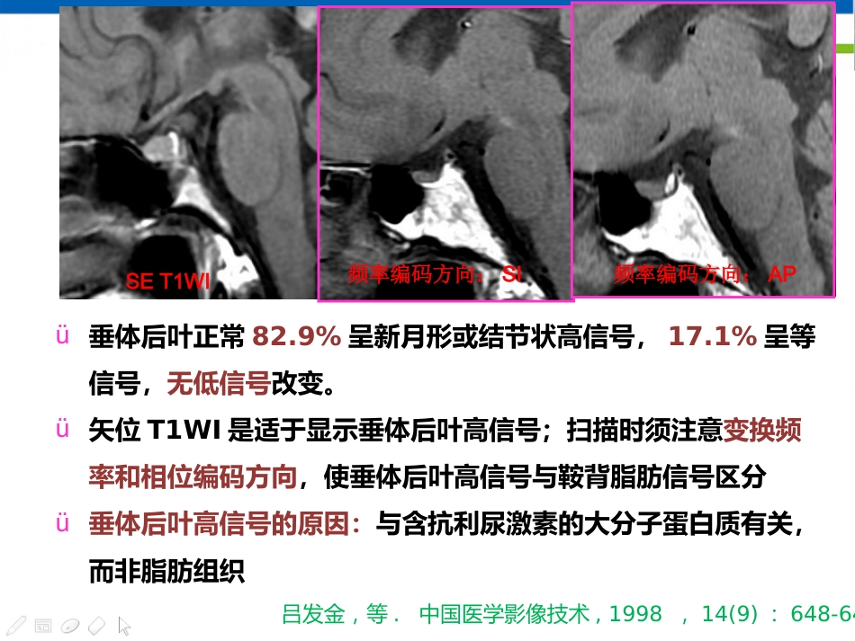 垂体病变的影像学诊断规范_第15页