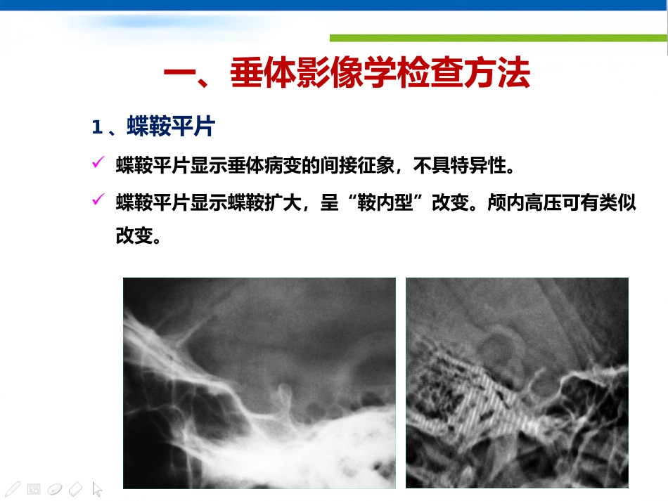 垂体病变的影像学诊断规范_第3页