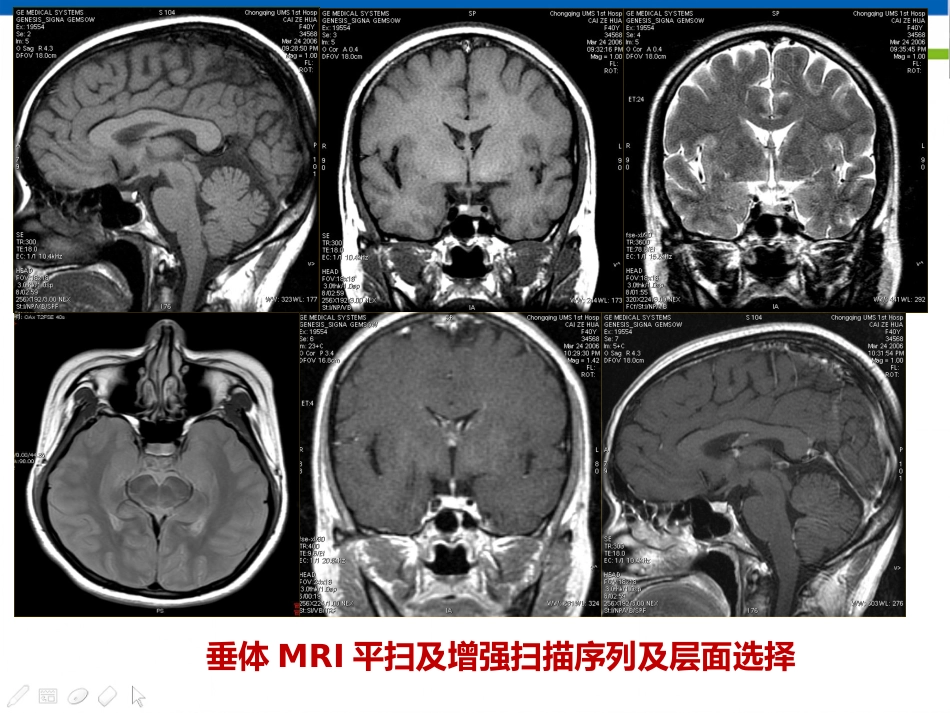 垂体病变的影像学诊断规范_第6页