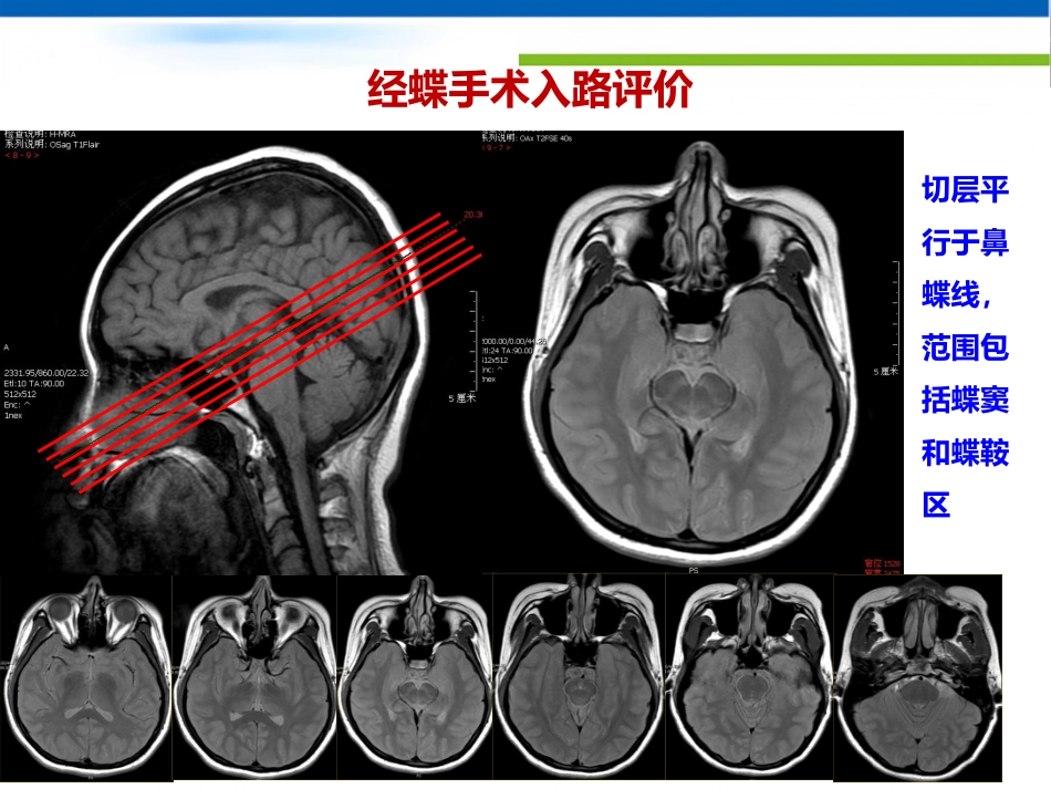垂体病变的影像学诊断规范_第7页