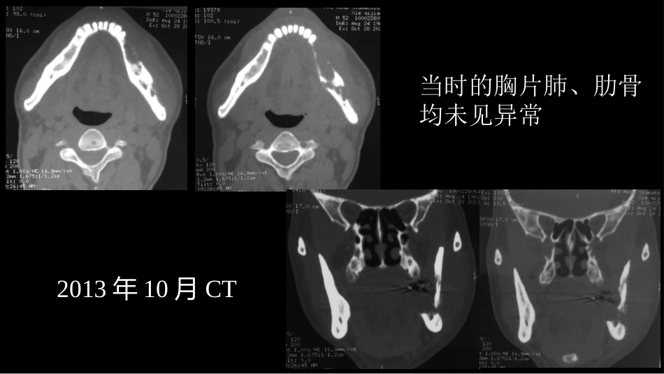 没有见过的弥漫性的骨质破坏_第15页