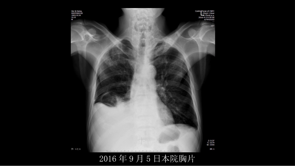 没有见过的弥漫性的骨质破坏_第4页