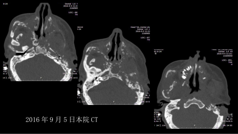 没有见过的弥漫性的骨质破坏_第5页