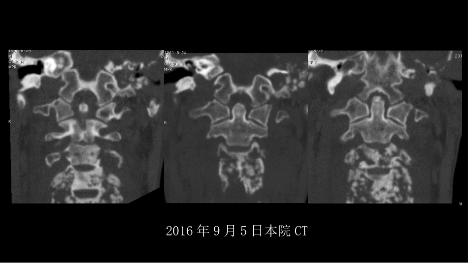 没有见过的弥漫性的骨质破坏_第9页