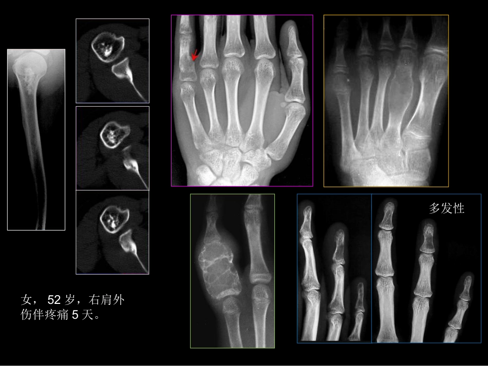 骨肿瘤影像学诊断_第10页