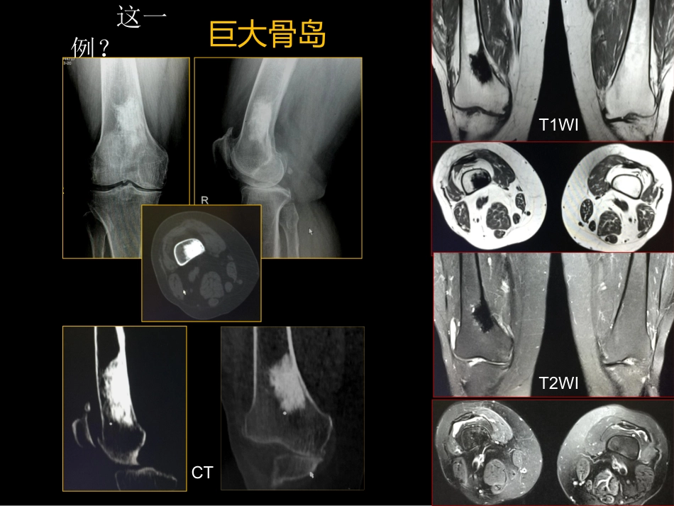 骨肿瘤影像学诊断_第12页