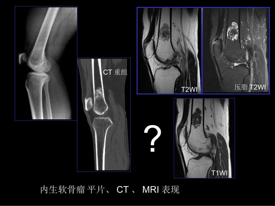 骨肿瘤影像学诊断_第13页