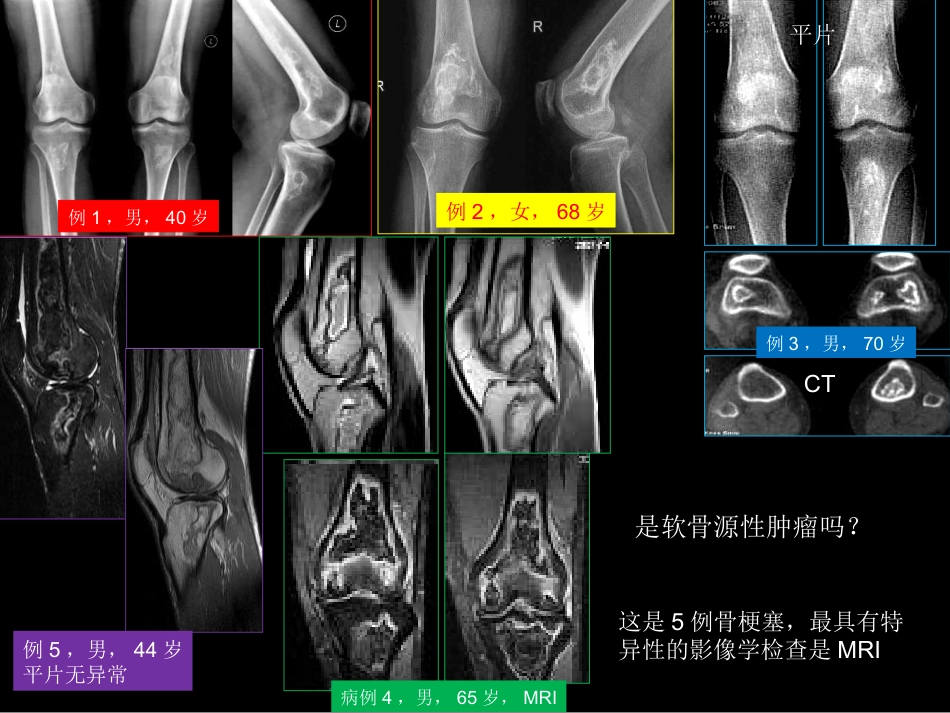 骨肿瘤影像学诊断_第14页