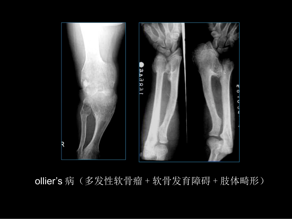 骨肿瘤影像学诊断_第15页