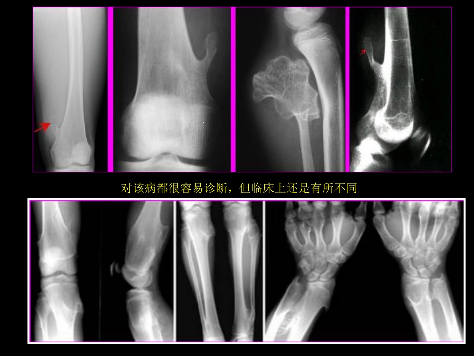 骨肿瘤影像学诊断_第5页