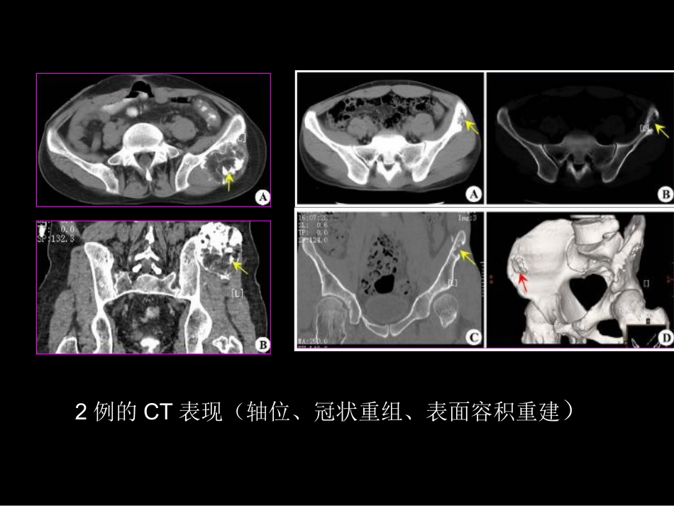 骨肿瘤影像学诊断_第6页