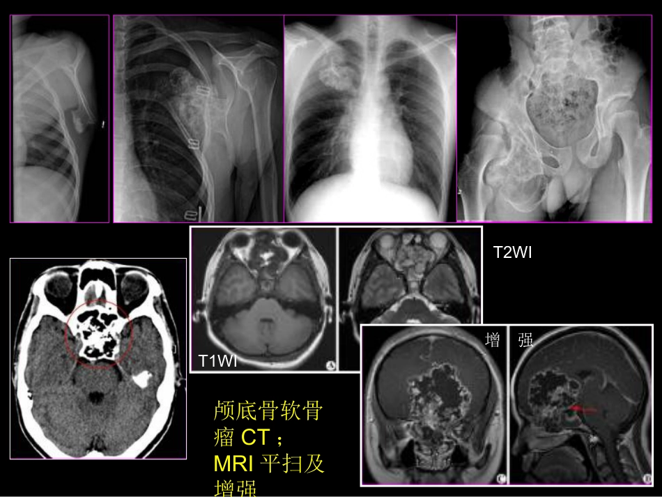 骨肿瘤影像学诊断_第7页