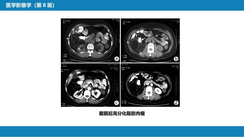 第八章 泌尿生殖系统与腹膜后间隙 第五节 腹膜后间隙_第13页