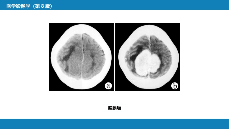 第二章 中枢神经系统 第四节 疾病诊断_第12页