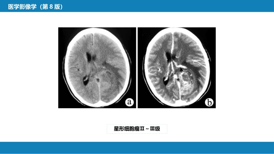 第二章 中枢神经系统 第四节 疾病诊断_第8页