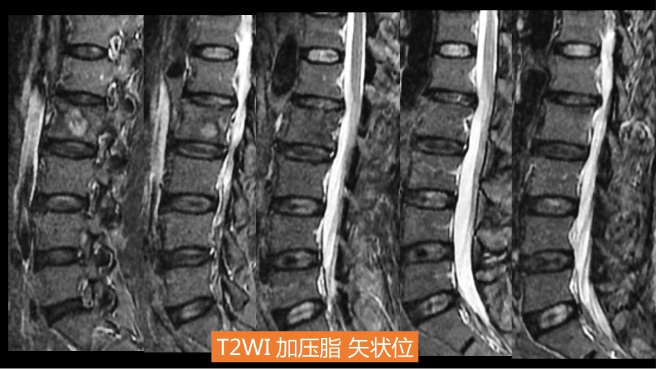 一例椎体的局灶病变影像表现分析暨影像诊断扩展_第10页