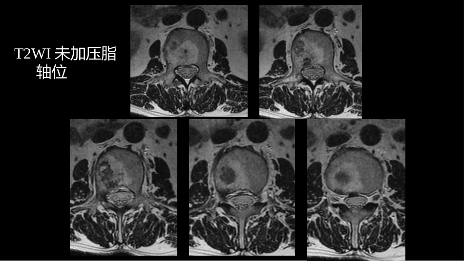 一例椎体的局灶病变影像表现分析暨影像诊断扩展_第11页