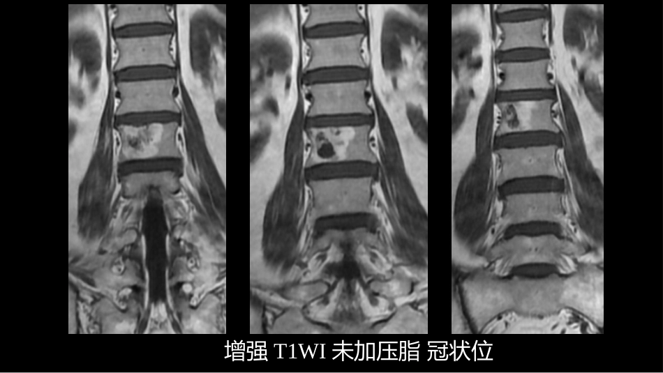 一例椎体的局灶病变影像表现分析暨影像诊断扩展_第12页