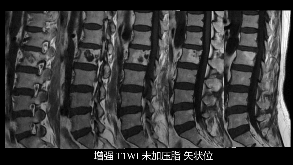 一例椎体的局灶病变影像表现分析暨影像诊断扩展_第13页