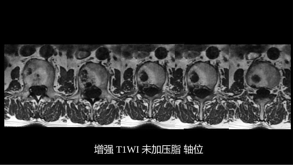 一例椎体的局灶病变影像表现分析暨影像诊断扩展_第14页