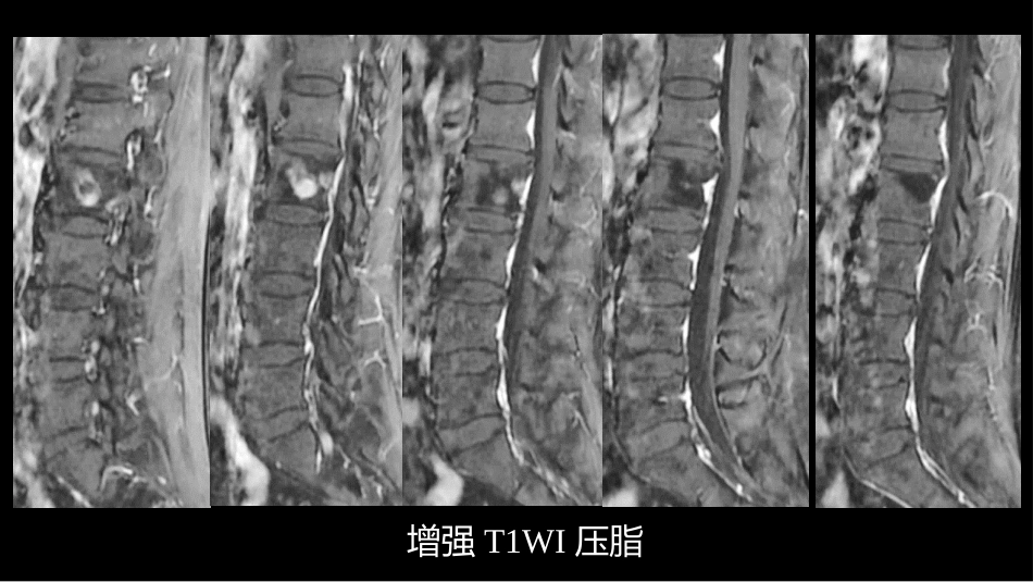 一例椎体的局灶病变影像表现分析暨影像诊断扩展_第15页
