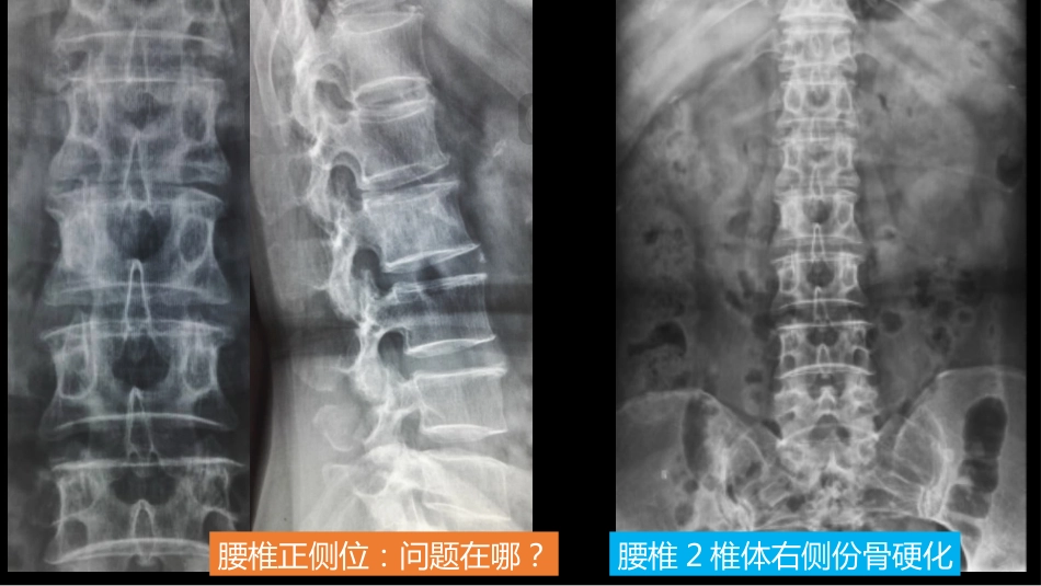 一例椎体的局灶病变影像表现分析暨影像诊断扩展_第3页