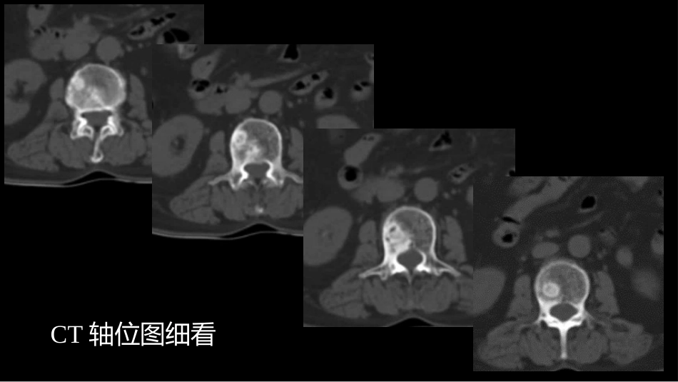 一例椎体的局灶病变影像表现分析暨影像诊断扩展_第4页