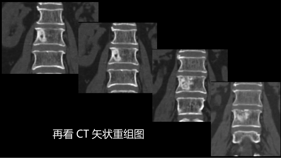 一例椎体的局灶病变影像表现分析暨影像诊断扩展_第5页