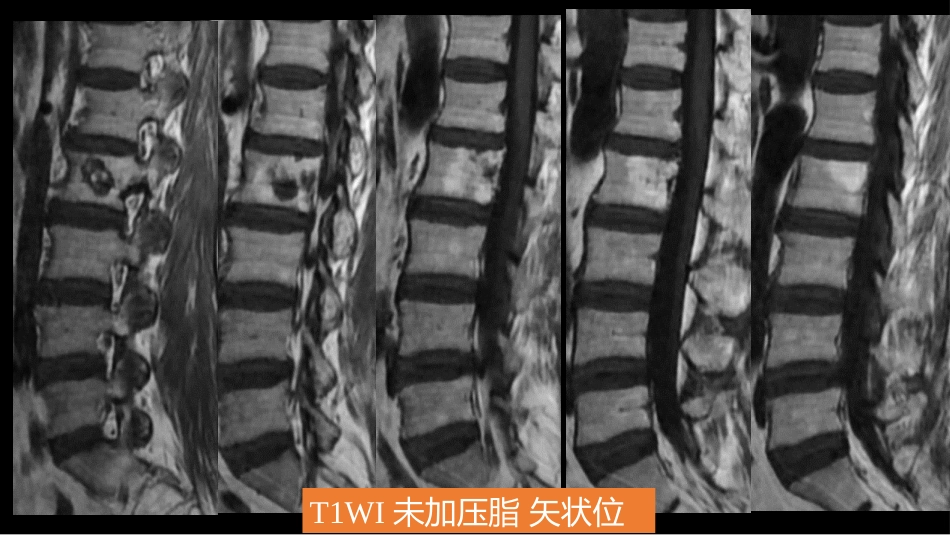 一例椎体的局灶病变影像表现分析暨影像诊断扩展_第8页
