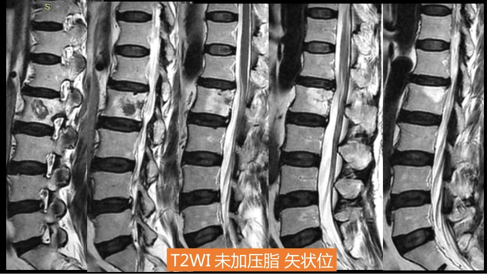 一例椎体的局灶病变影像表现分析暨影像诊断扩展_第9页