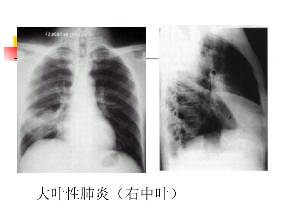 大叶性肺炎的影像诊断-23页_第10页