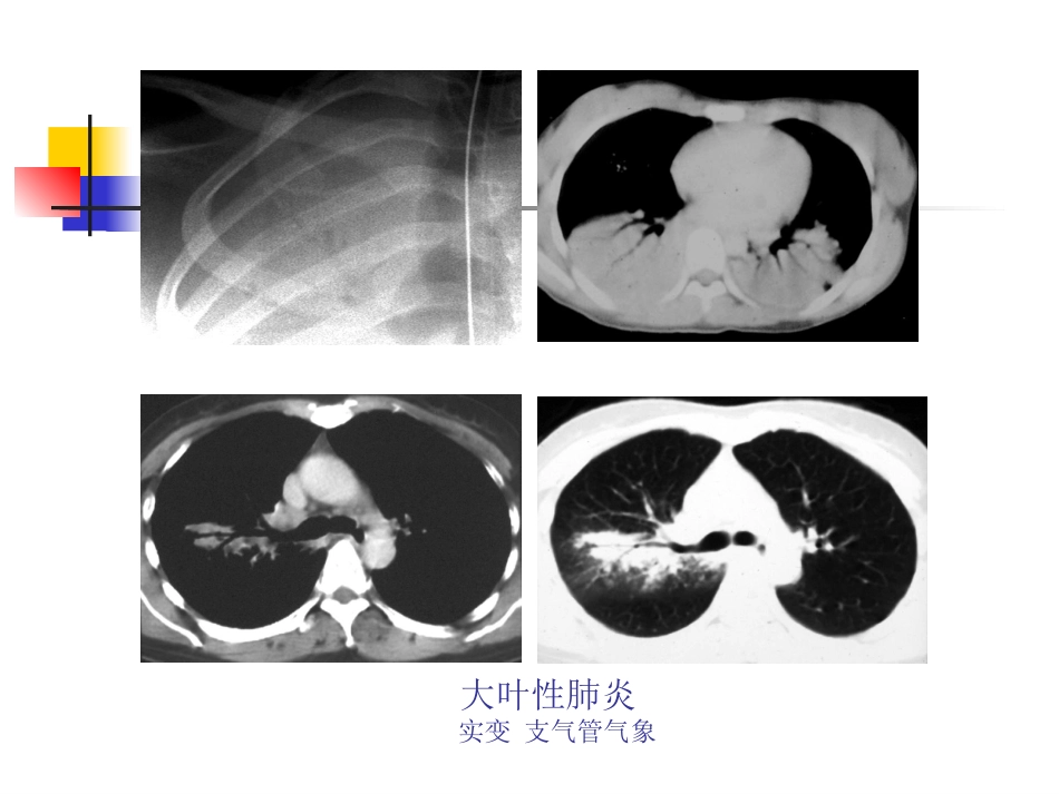 大叶性肺炎的影像诊断-23页_第12页