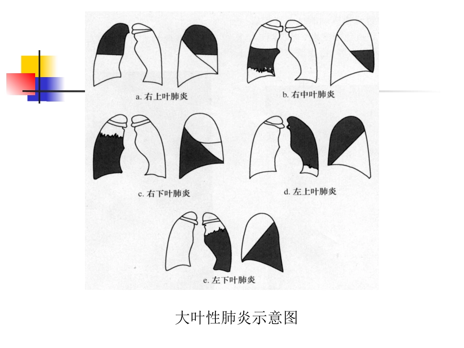 大叶性肺炎的影像诊断-23页_第14页