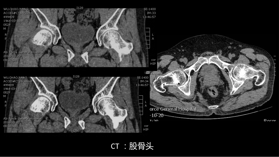 影像诊断学习与扩展：代谢性骨病(病例23)_第6页
