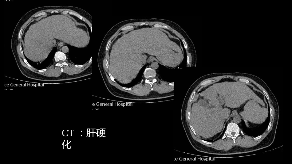 影像诊断学习与扩展：代谢性骨病(病例23)_第8页