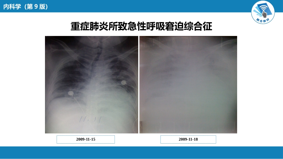 呼吸系统疾病：急性呼吸窘迫综合征_第8页